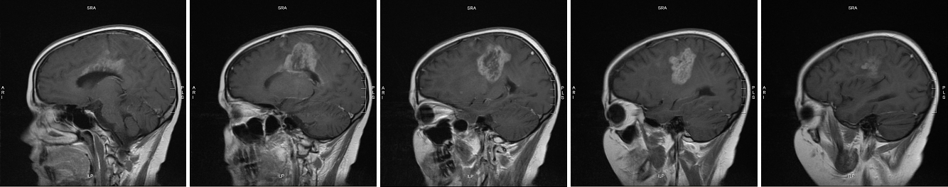 side view September MRI series